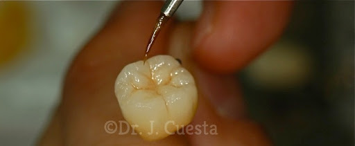 Implantologia Estética Dr. J. Cuesta